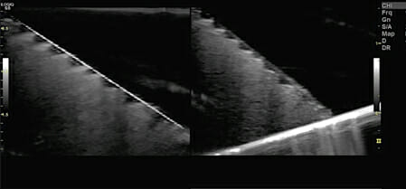 Ultrasound image of biopsy needle advancing into the tissue for a small diagnostic sample