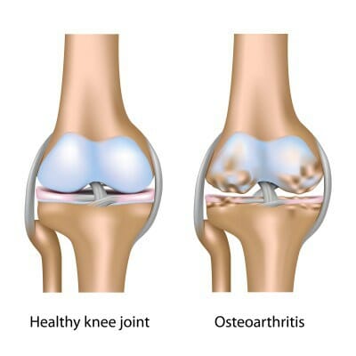 Diagram showing a healthy knee joint and osteoarthritis