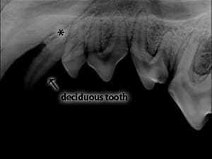 Dental radiograph with an arrow pointing at a deciduous tooth