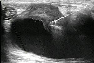 Ultrasound image of a precise placement of a needle illustrated with directional enhancement