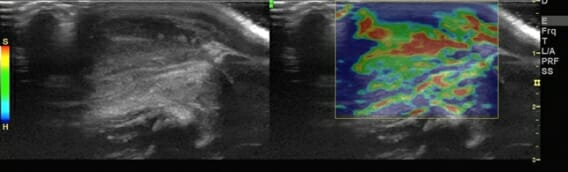 Elastography image of a mass in a neck indicating an infection