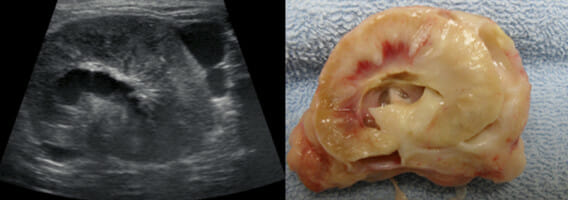 An ultrasound and real life image of a kidney tumour