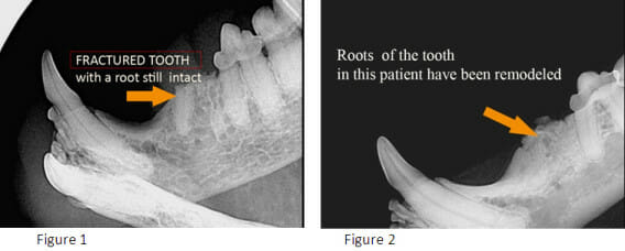 X-ray images of a fractured tooth with a root still intact and remodelled roots of a tooth